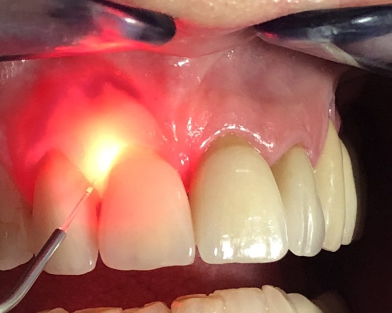 Laser for Gum Contouring