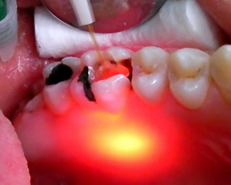 Root Canal Disinfection with laser